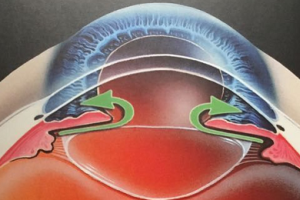 青白联合 共筑光明——2026何氏眼科青光眼白内障联合防治月启幕